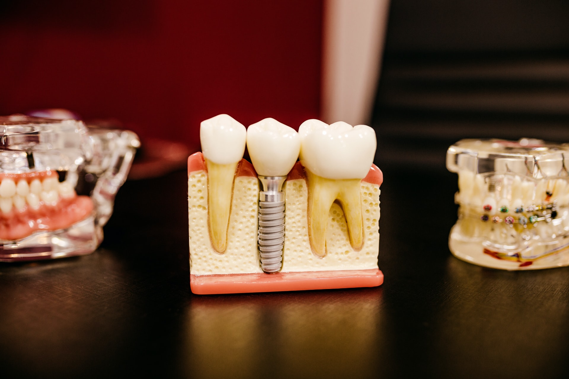 Does Medicaid Cover Dental Implants?