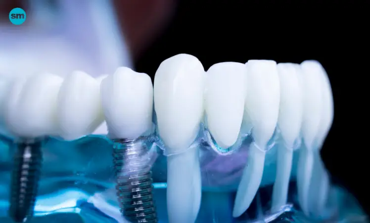 In-House Financing for Dental Implants