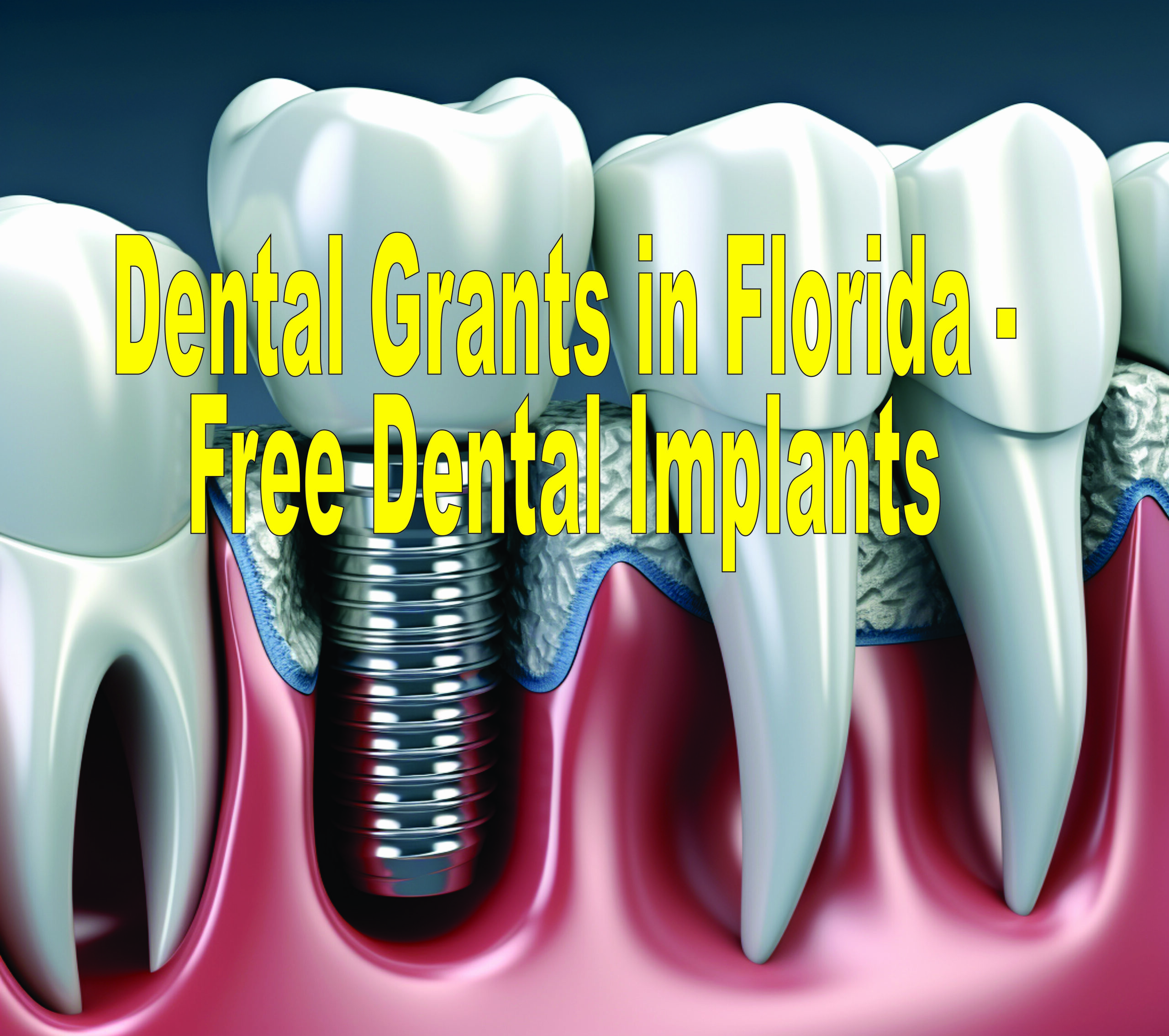 Dental Grants In Florida Free Dental Implants